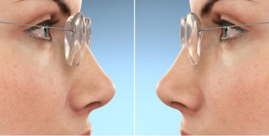 👓 Tròng Kính Siêu Mỏng – Nhẹ, Trong Suốt, Thẩm Mỹ Cao